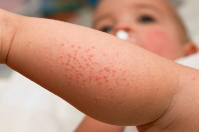Ways to Beat Childhood Eczema